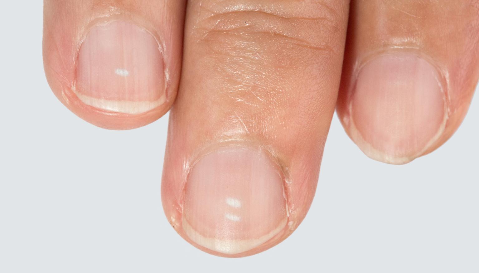 white-spots-on-nail-indicate-calcium-deficiency-biggest-myth-ever