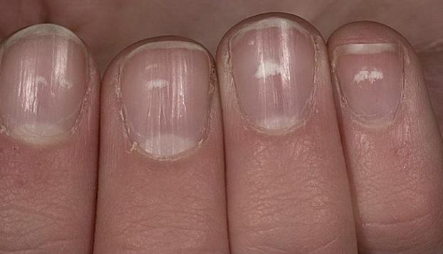 ridges-in-fingernails-toenails-vertical-horizontal-vitamin