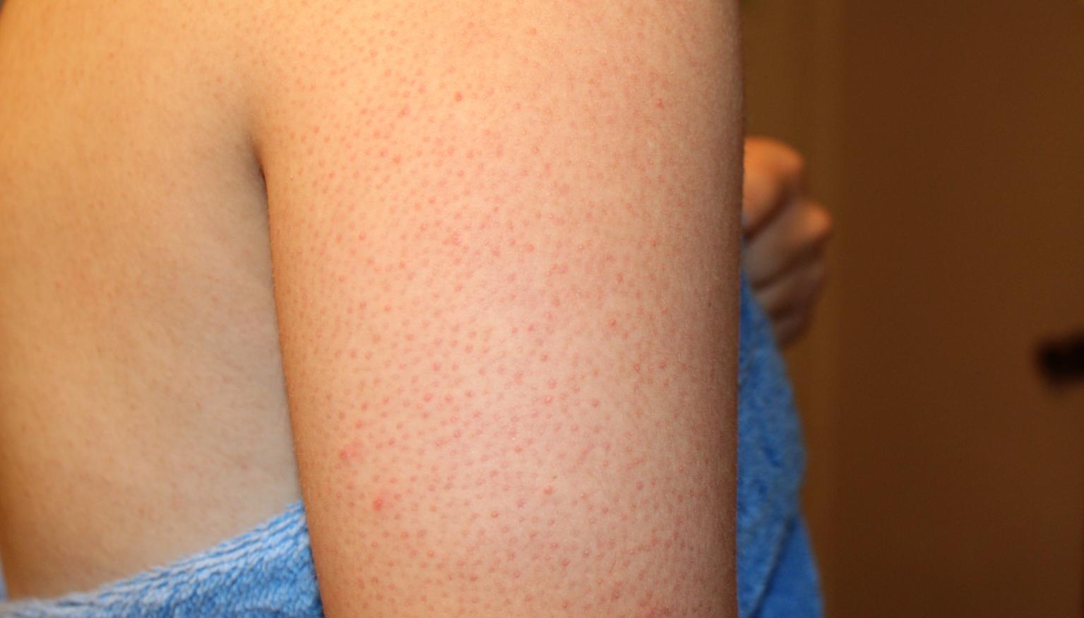 why-red-dots-appear-on-your-arms-and-how-to-get-rid-of-them-mirror